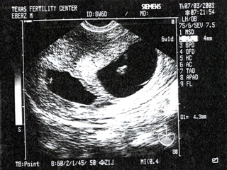 Mojo's Fetus 2